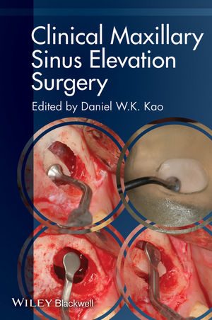 Clinical Maxillary Sinus Elevation Surgery book cover