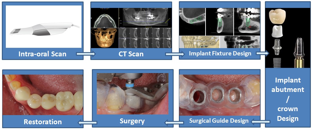 Digital work-flow of Dental Implant