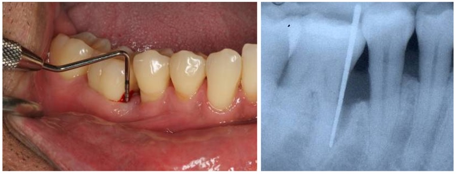 Severe gum disease clinical photo and X-ray