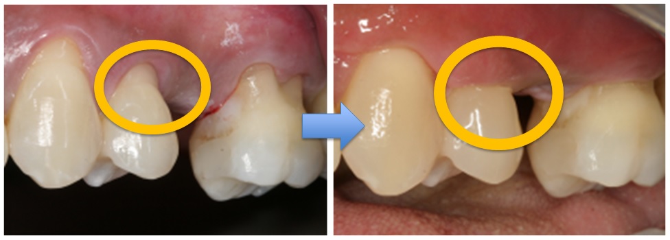 Gum Recessing Treatment