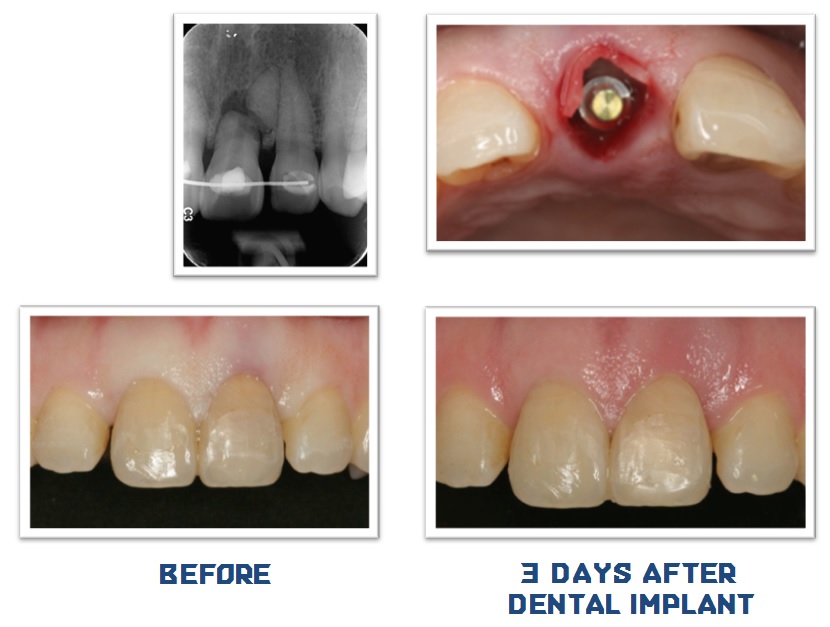 One day Dental Implant — before and 3 days after dental implant