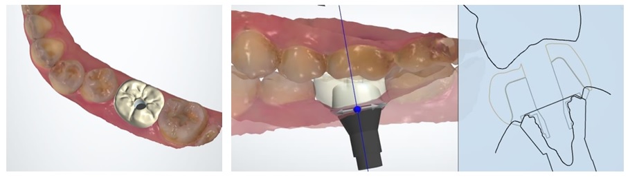 Digital Dental Implant